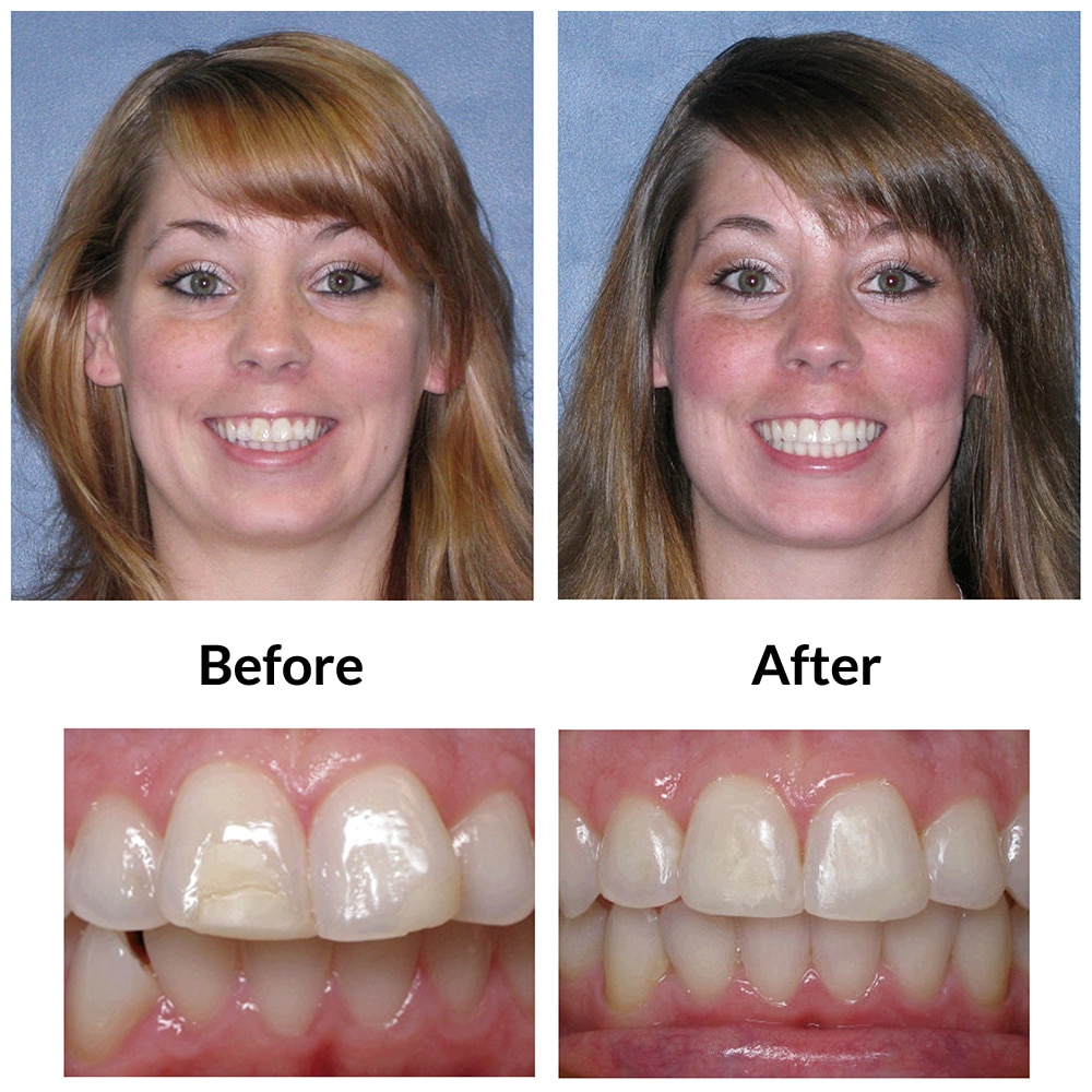 Invisalign Before and After Image